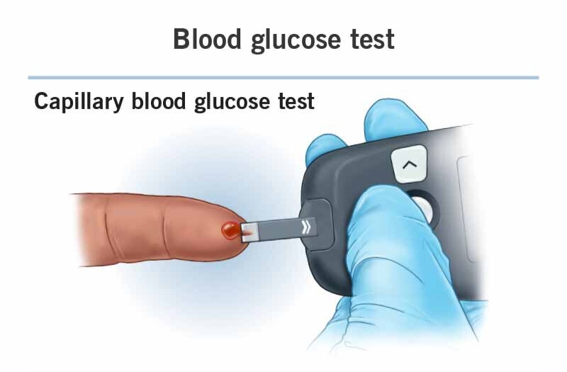 A medical illustration showing two ways to test blood sugar. The top section, labeled "Capillary blood glucose test," shows a person in blue gloves using a portable glucose meter to take a blood sample from a finger prick. The bottom section, labeled "Venous (plasma) blood glucose test," shows a healthcare professional drawing blood from a patient’s arm using a syringe and a blue tourniquet.