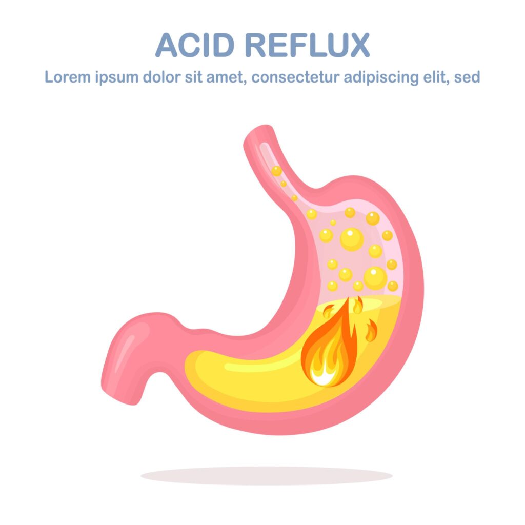 acidity reflux image