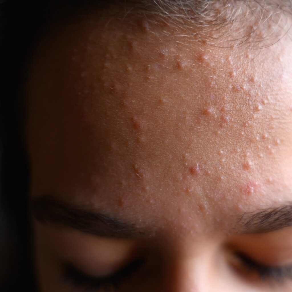A high-resolution, close-up photograph of a person's forehead showing a breakout of inflammatory acne. Multiple small, red papules and pustules are visible against the skin, concentrated between the eyebrows and the hairline.