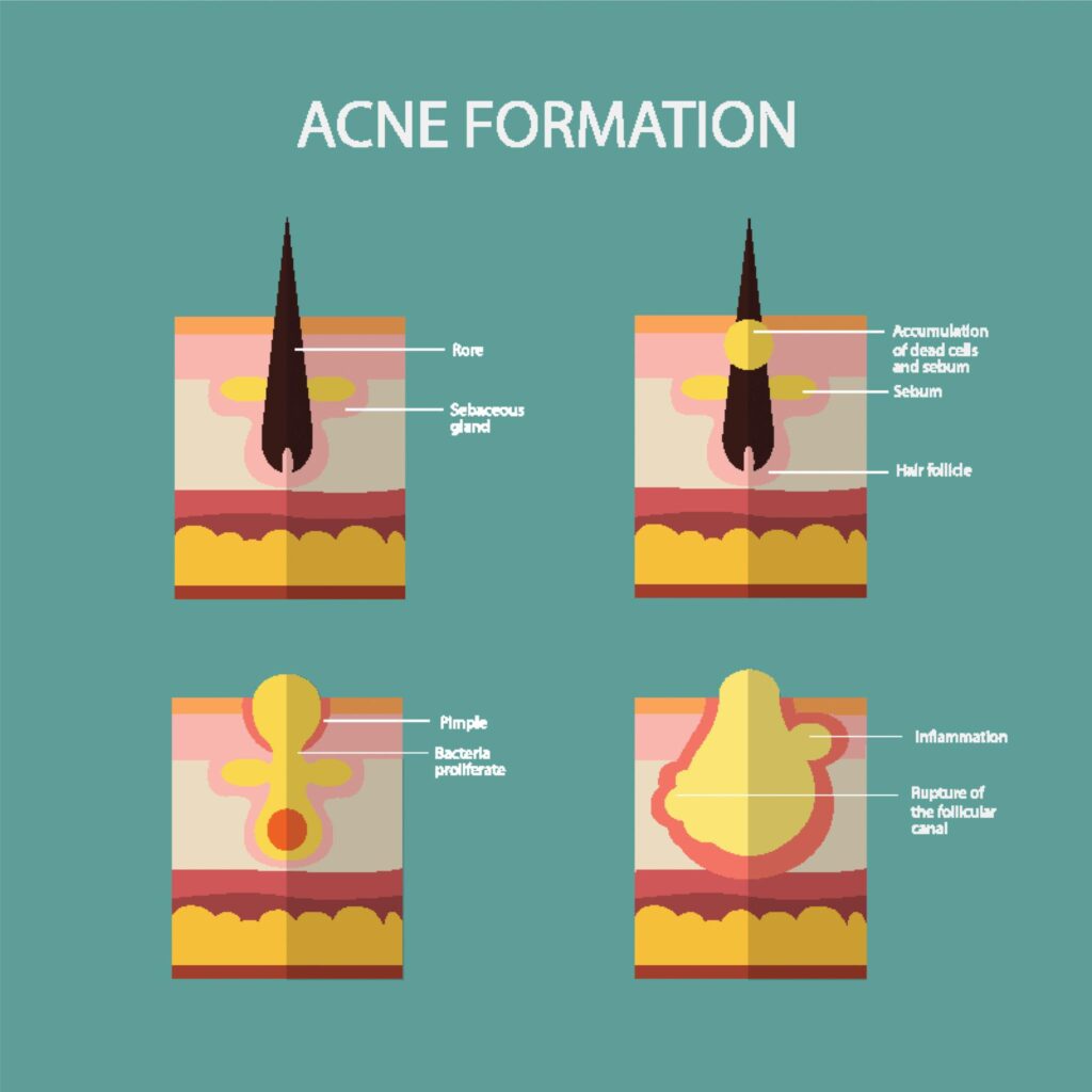 A 4-step infographic titled "ACNE FORMATION." It illustrates the progression from a healthy pore to a ruptured lesion: 1) Normal pore, 2) Accumulation of dead cells and sebum, 3) Bacterial proliferation forming a pimple, and 4) Inflammation leading to the rupture of the follicular canal. Acne
