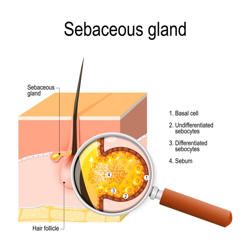 A detailed cross-section diagram of human skin showing a hair follicle and an attached sebaceous gland. A magnifying glass highlights the internal structure of the gland, labeling the basal cells, undifferentiated sebocytes, differentiated sebocytes, and the production of sebum.