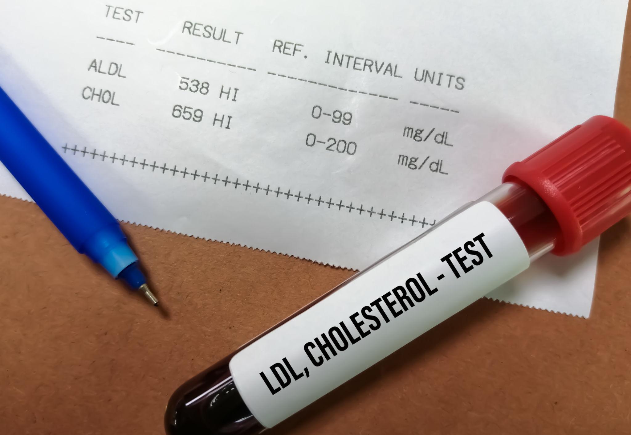 Several medical glass vials filled with blood samples and capped with red tops, organized in a lab rack for lipid profile or cholesterol testing.