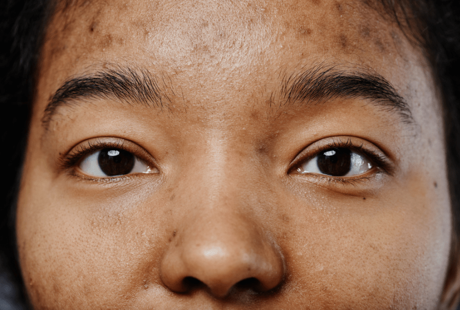 Pigmentation treatment concept with skincare and healthy skin care routine